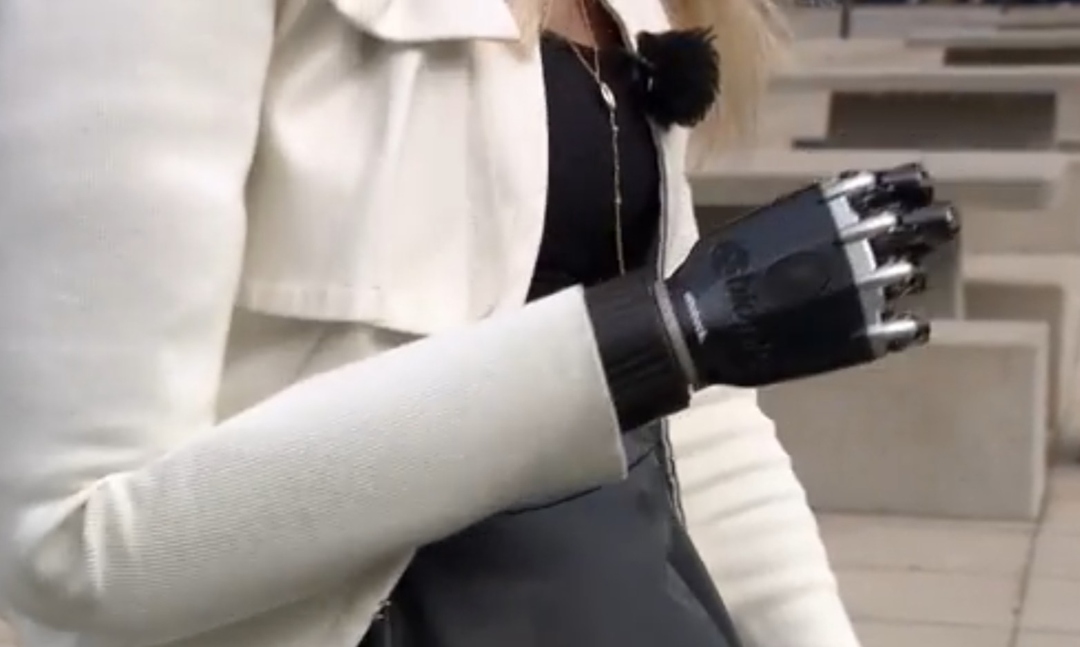 La main bionique contr&ocirc;l&eacute;e par la pens&eacute;e change la vie de patients fran&ccedil;ais  - Chirurgie M&eacute;decine Nantes Proth&egrave;ses Sant&eacute; S&eacute;curit&eacute; Sociale T&eacute;moignage Vid&eacute;o